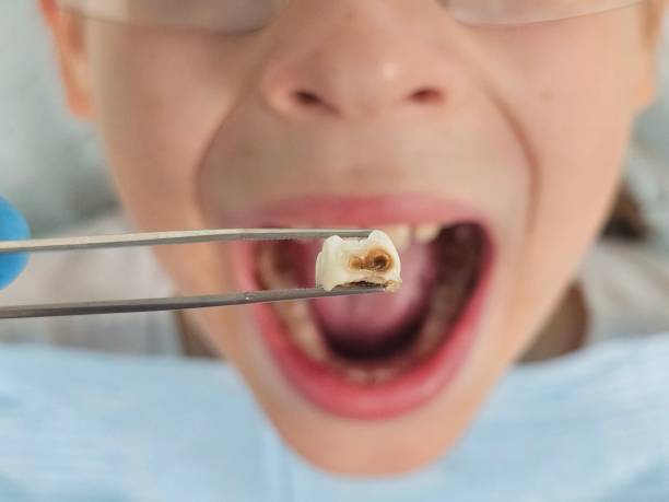 Best Emergency Tooth Extraction  in Itasca, TX